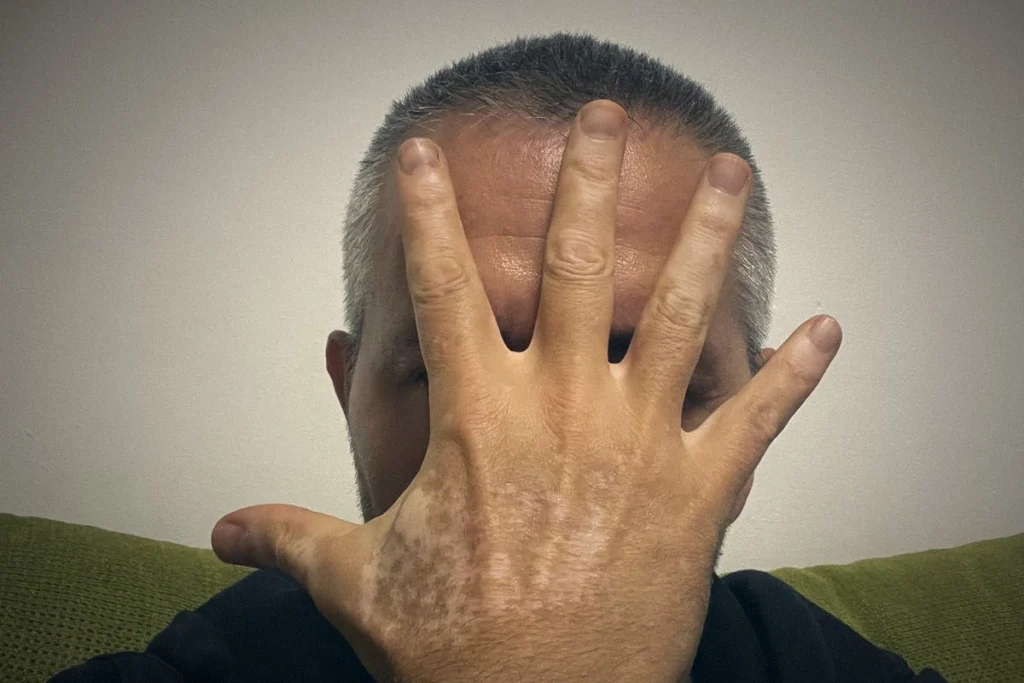 Sebastian covering his face with his hand, showing vitiligo patches on the back of his hand