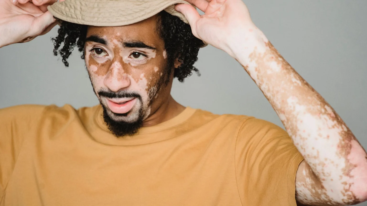 Portrait of a confident man with vitiligo wearing a yellow T-shirt and hat